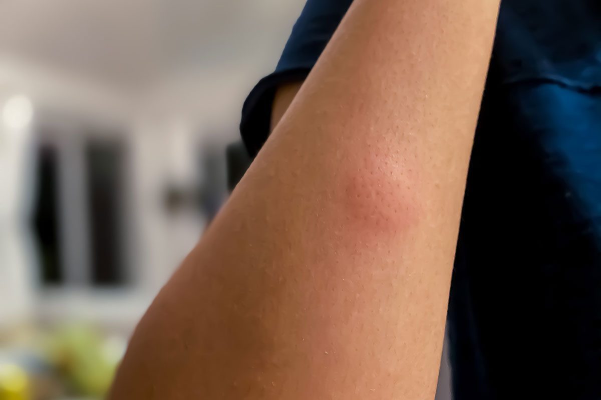 How to Get Rid of Itchy Mosquito Bites